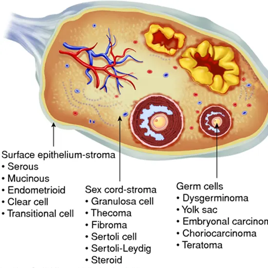 Ovarian Germ Cell Tumor
